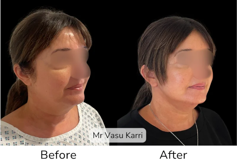 Facelift Patient 18 View 2